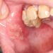 A Global Health Crisis: The Silent Epidemic of Oral Diseases