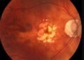 macular disease research grants funding opportunities